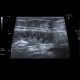 Acute enteritis, enteritis, edema of the valvulae conniventes: US - Ultrasound